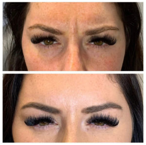 Before and after of Botox treatment