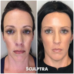 Sculptra results on woman