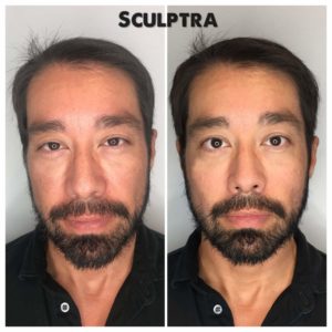 Man before and after receiving Sculptra treatment