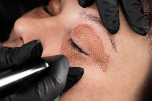 Women eyelid lifting, fibroblast procedure.