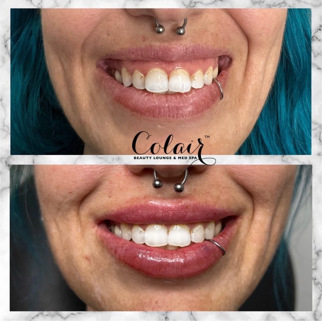 Treating Gummy Smile With Botox Colair Beauty Lounge