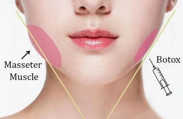 Masseter Botox Slim Your Jawline Without Surgery