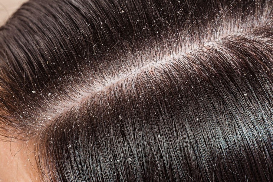 Scalp Health 101 The Foundation of Beautiful Hair
