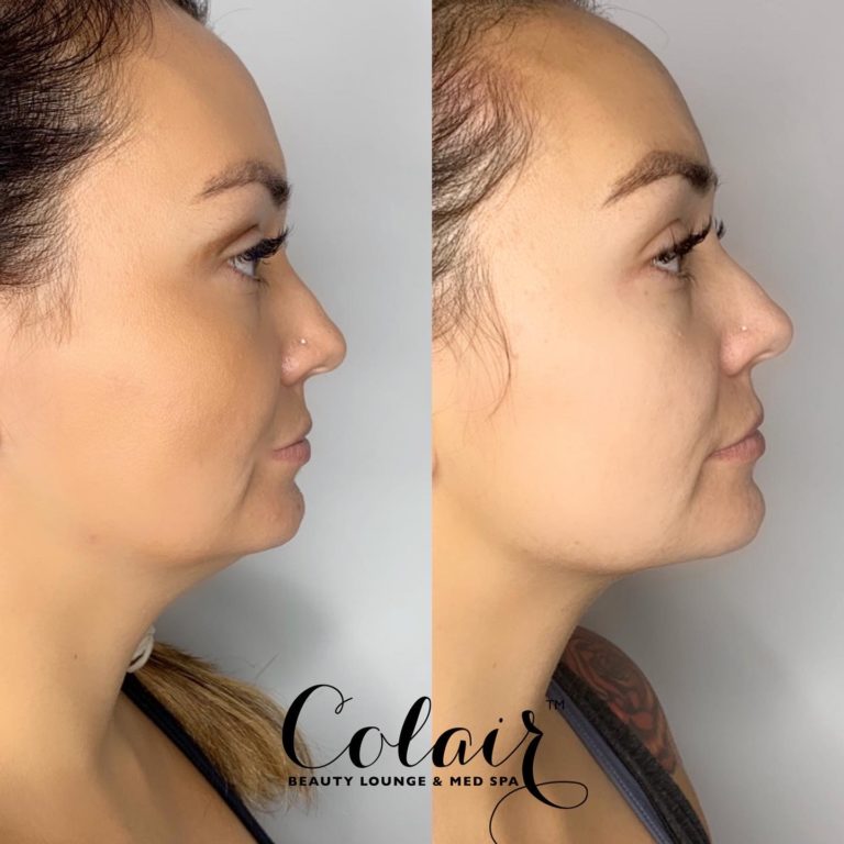 Colair patient before and after kybella treatment