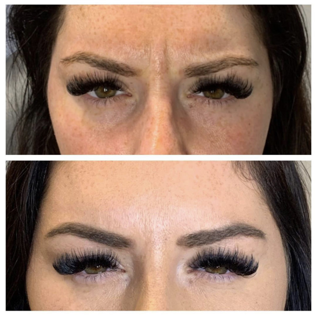 before and after botox injection on forehead