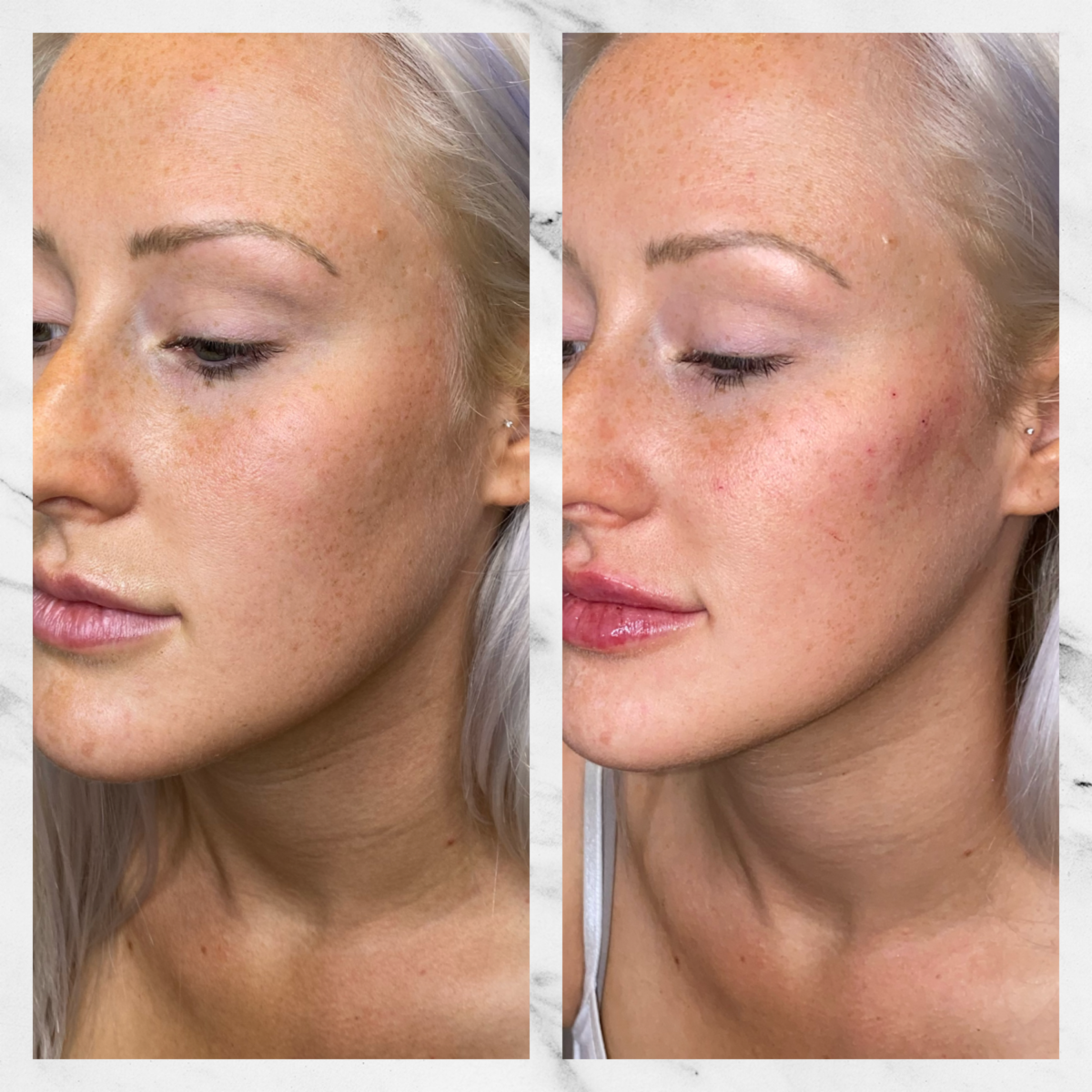 contour cheeks with filler