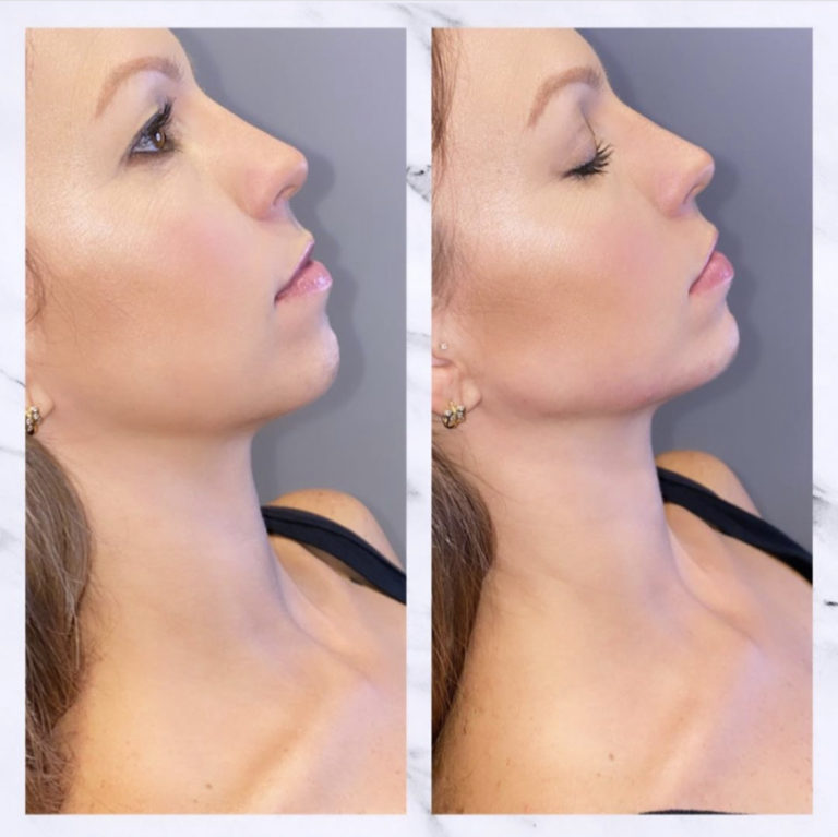 Chin & Jawline Fillers in Gilbert AZ Colair Med Spa
