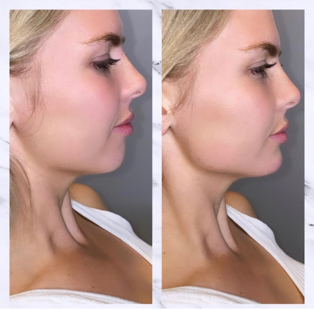 chin fillers before and after