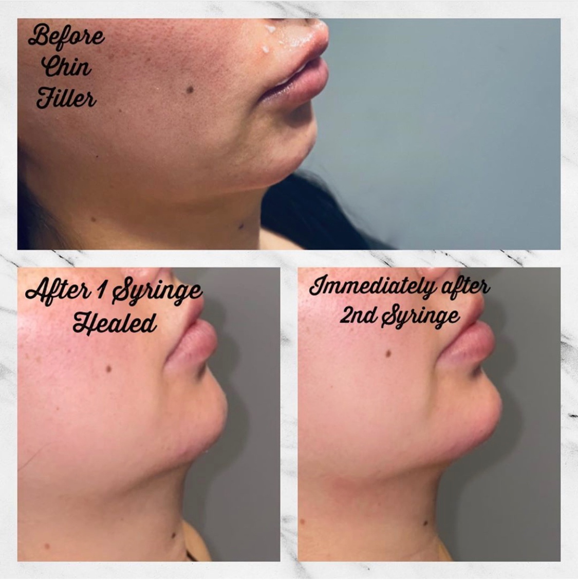 Chin & Jawline Fillers in Gilbert AZ Colair Med Spa