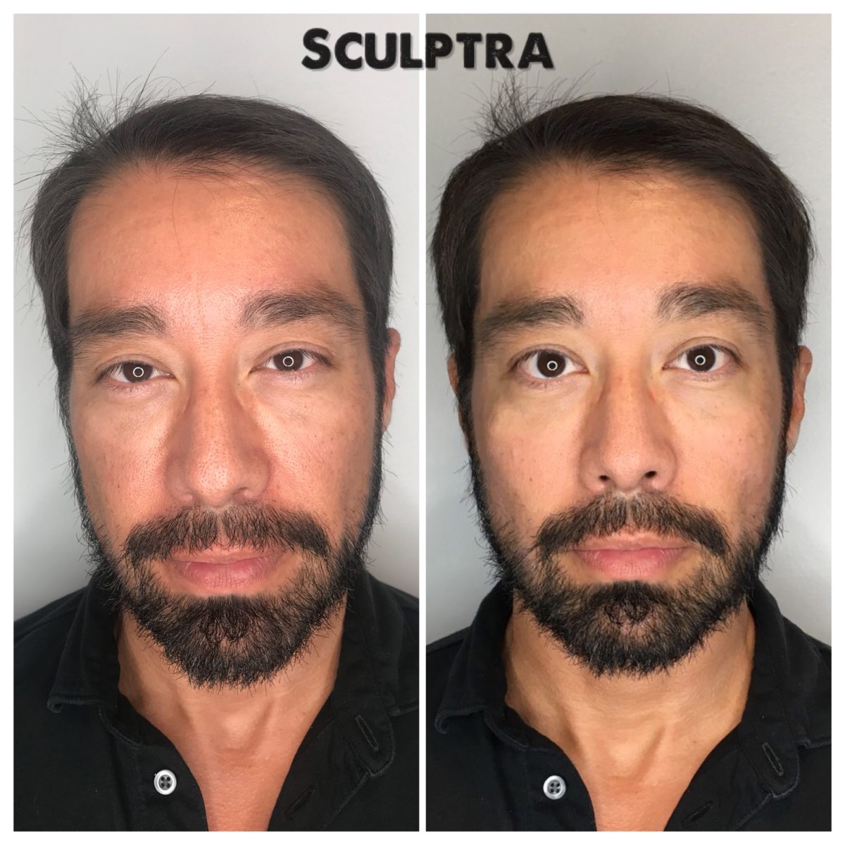 Sculptra Aesthetic Injections in Gilbert AZ Colair Med Spa