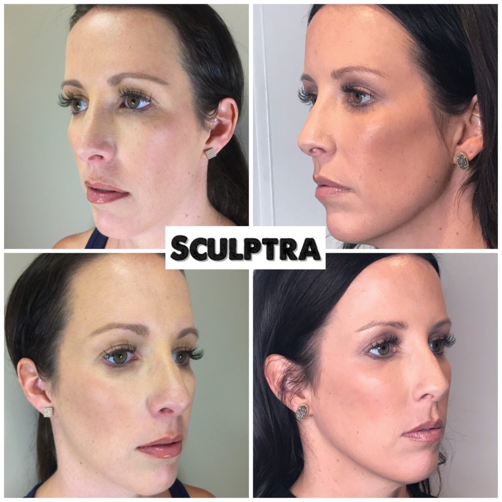 Sculptra Aesthetic Injections In Gilbert Az Colair Med Spa