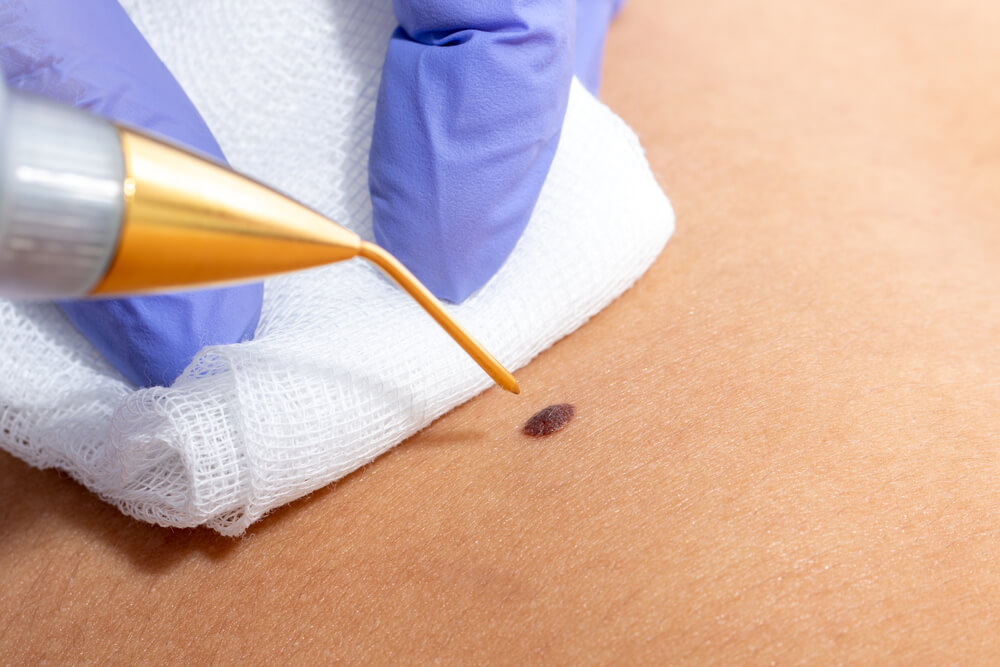 plasma pen procedure removing mole from skin