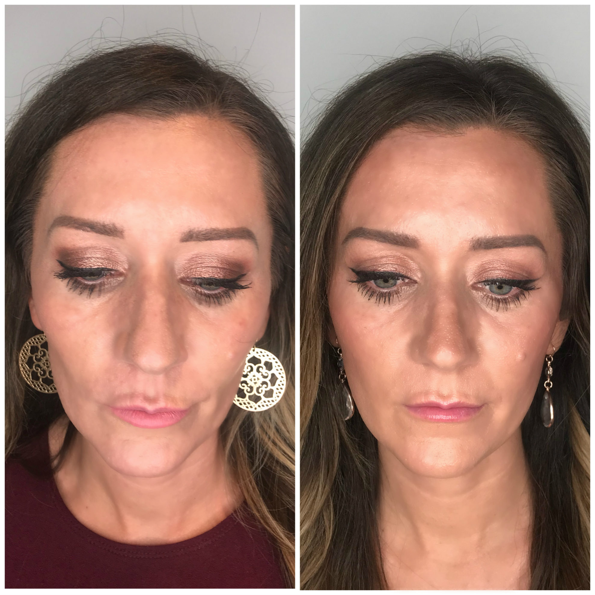 Sculptra Aesthetic Injections in Gilbert AZ Colair Med Spa