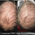 man before and after prp hair treatment