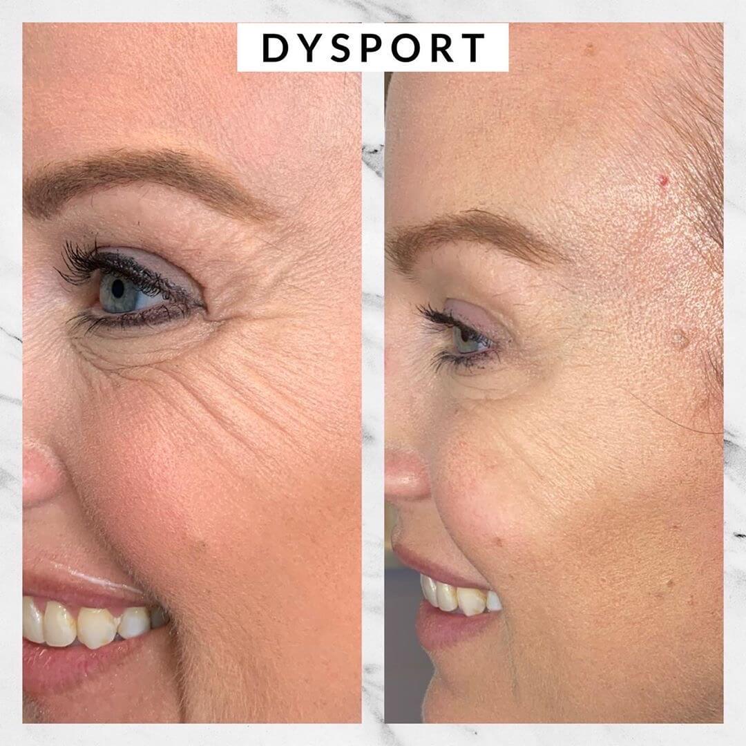 Dysport crows feet
