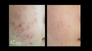 Scarlet SRF treatment for acne