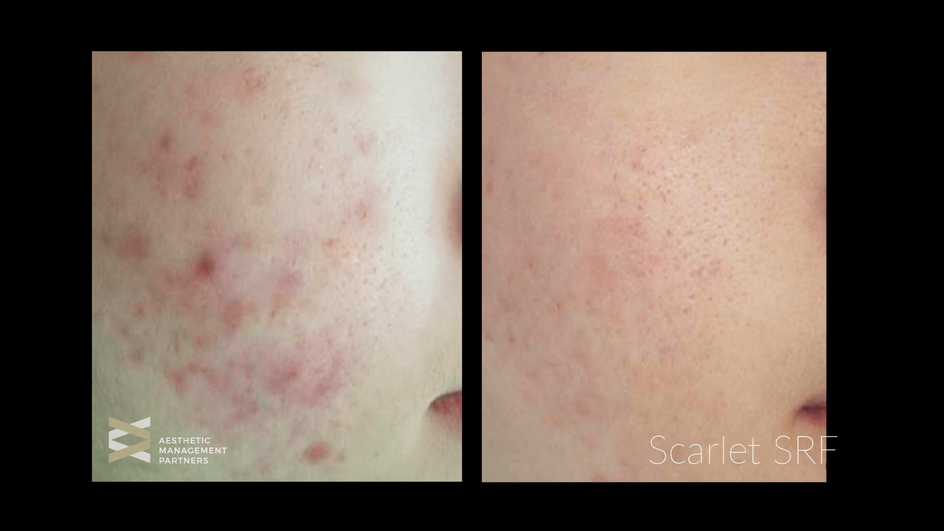 Get Rid of Acne Scars for Good Colair Beauty Lounge