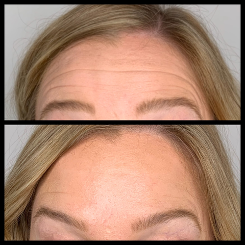 a comparison of before and after botox