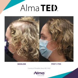 Alma Ted treatment before and after
