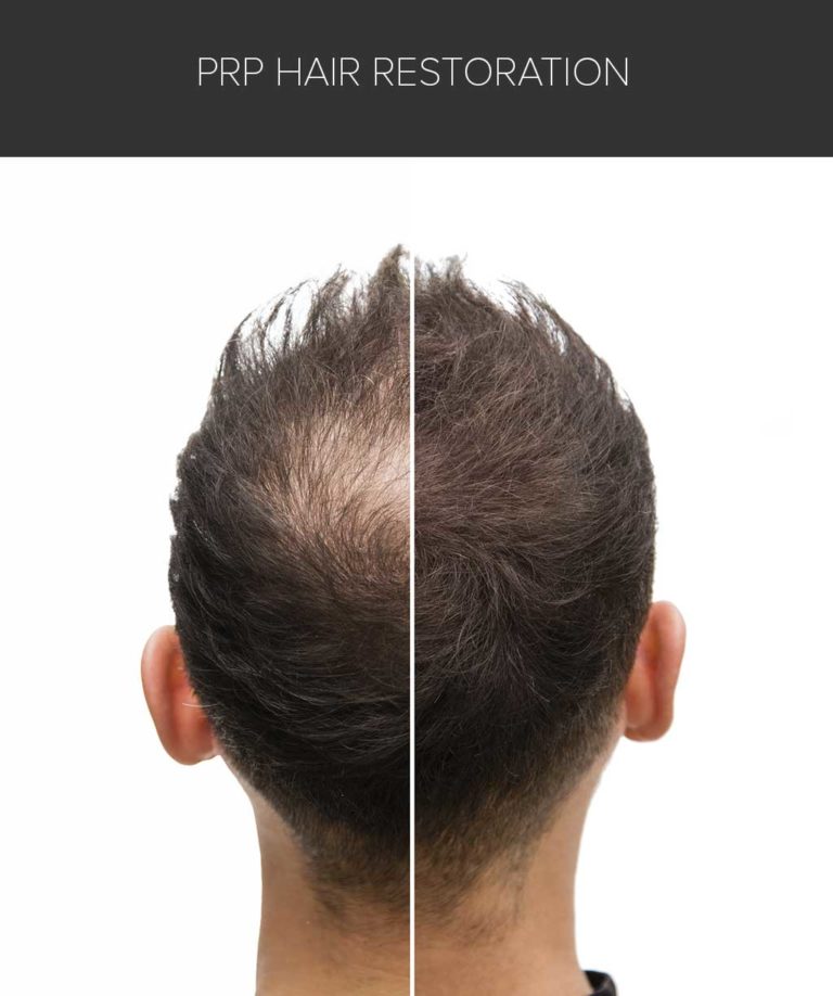 hair-restoration-image-prp