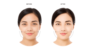 Masseter Botox: Slim Your Jawline Without Surgery