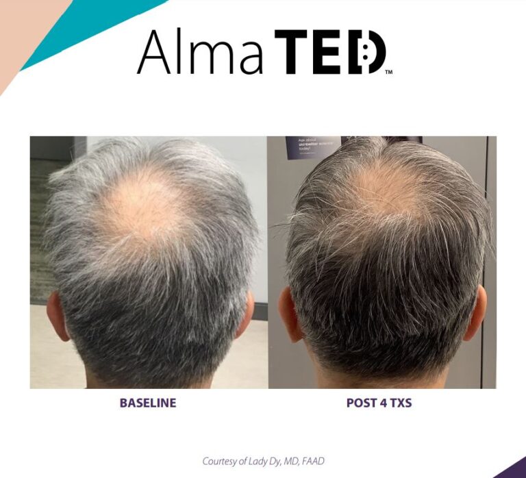 Everything You Need to Know About Alma TED