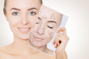 Clear Skin, Confident You Proven Acne Solutions at Colair for Acne Awareness Month