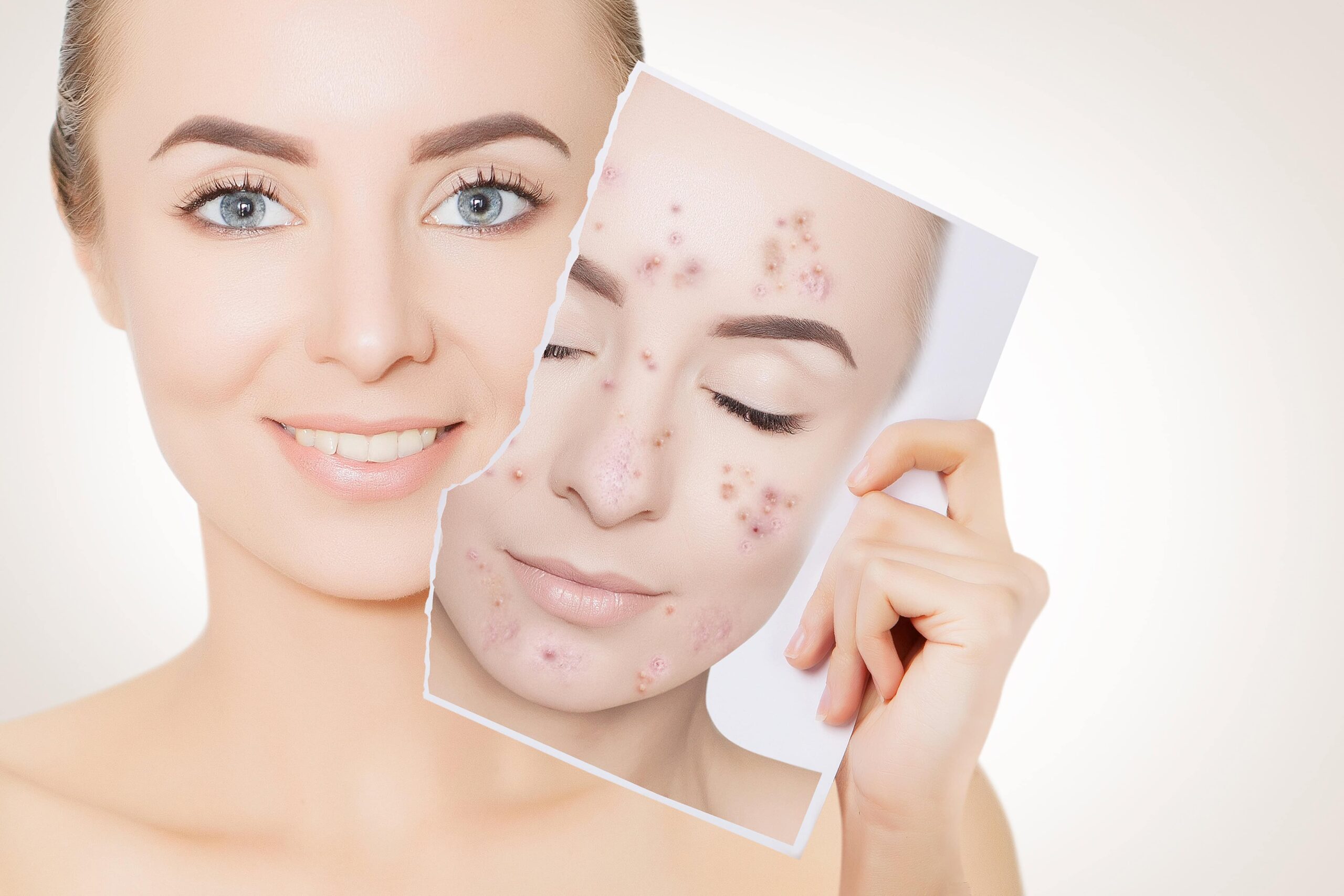 Clear Skin, Confident You Proven Acne Solutions at Colair for Acne Awareness Month