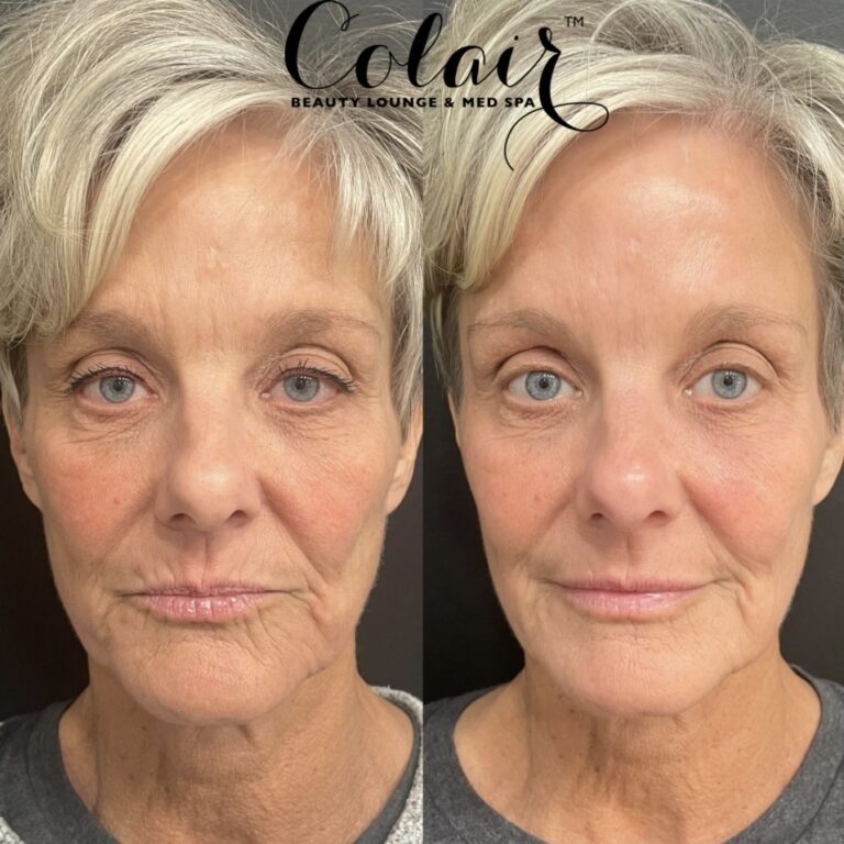 Sculptra Treatment Colair Beauty Lounge and Medspa