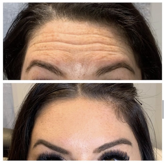 Dysport Days at Colair