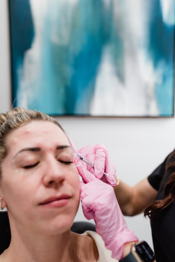 Crows feet botox (2)