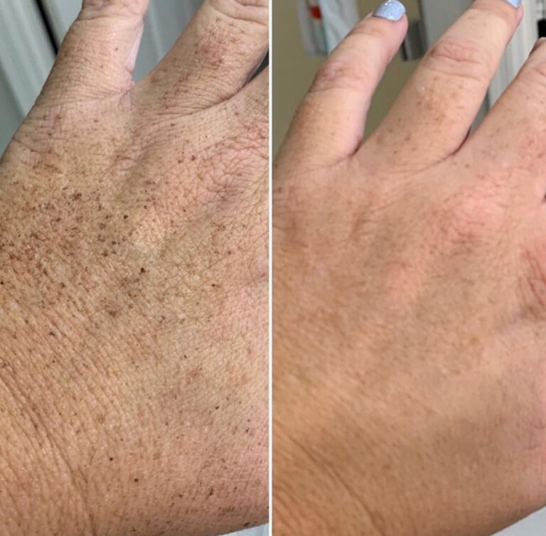 Photofacial before and afters -1