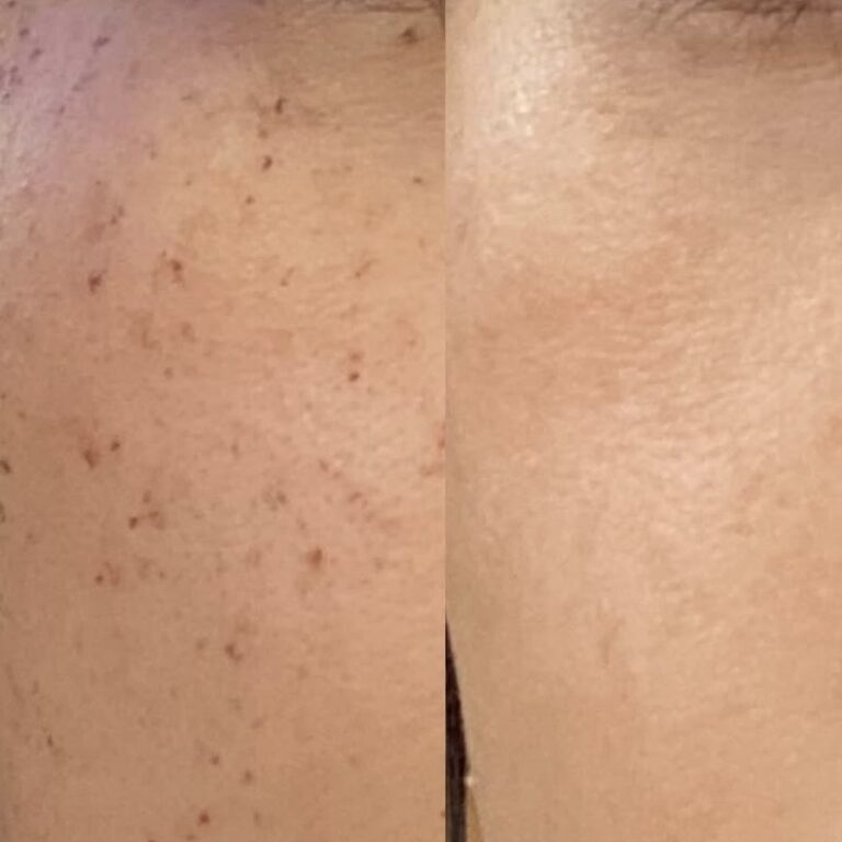 Photofacial before and afters -2