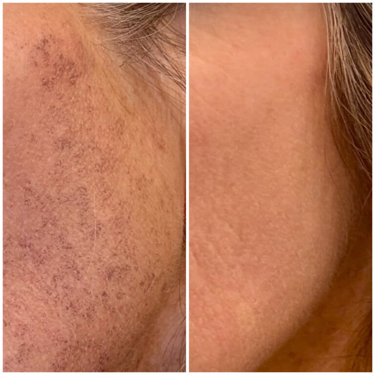 Photofacial before and afters -3