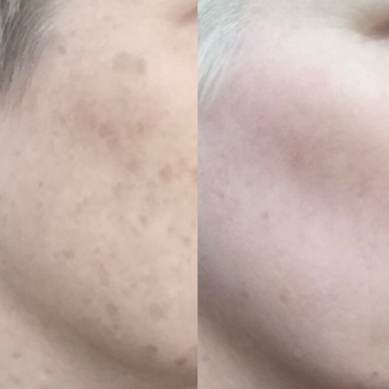 Photofacial before and afters -4