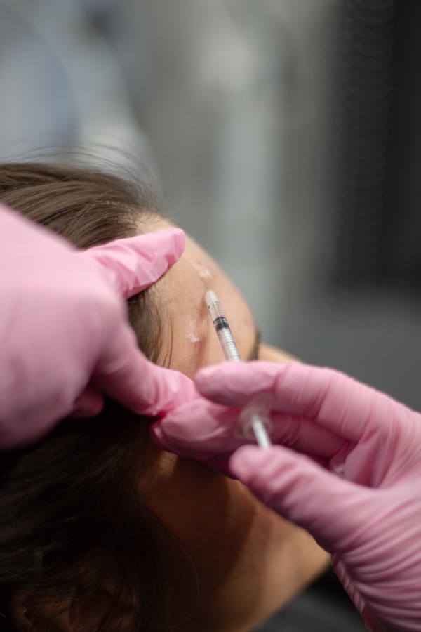 forehead botox (3)