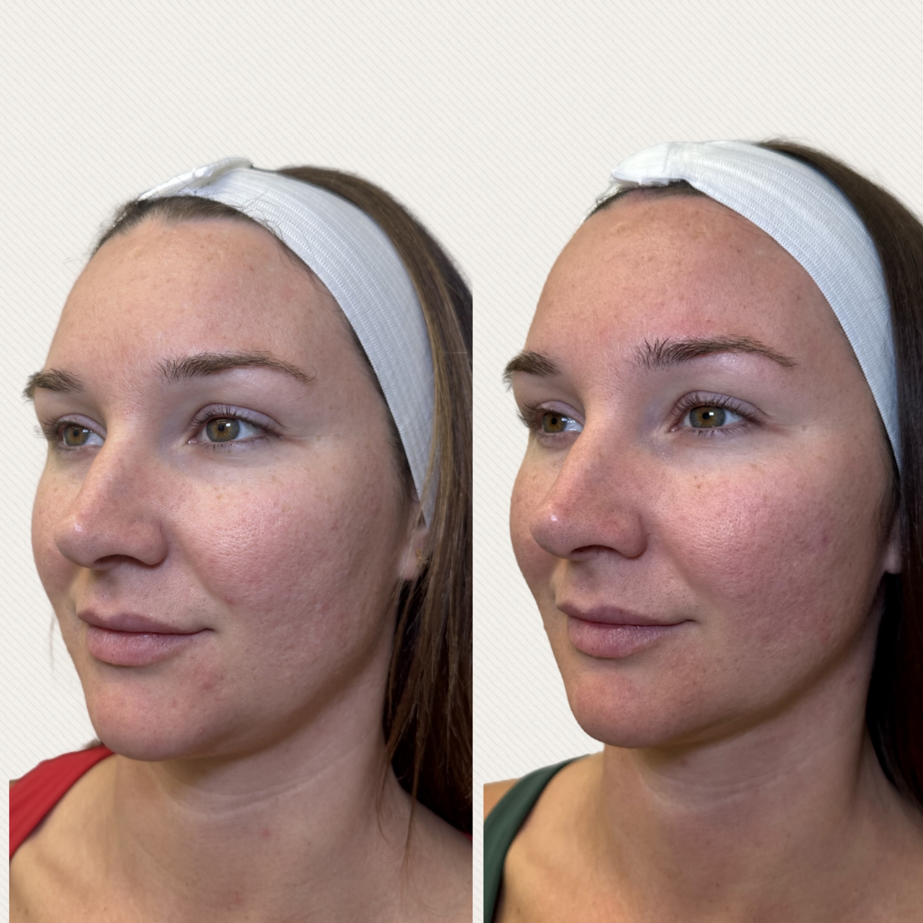 FREE DiamondGlow Facial with a Complete SKINVIVE Treatment