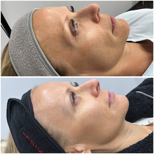 $100 OFF PRP VAMPIRE FACIAL